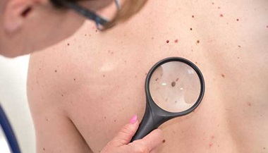 Dermatologist checks a mole on a patient's back
