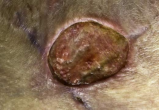 A close up of a skin injury infected with MRSA.