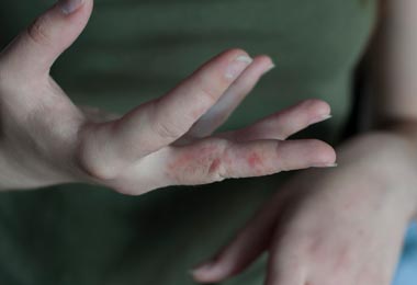 Speed Stick Rash Drug Rashes | Johns Hopkins Medicine