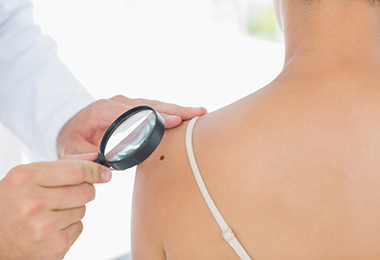 magnifying mole woman's shoulder