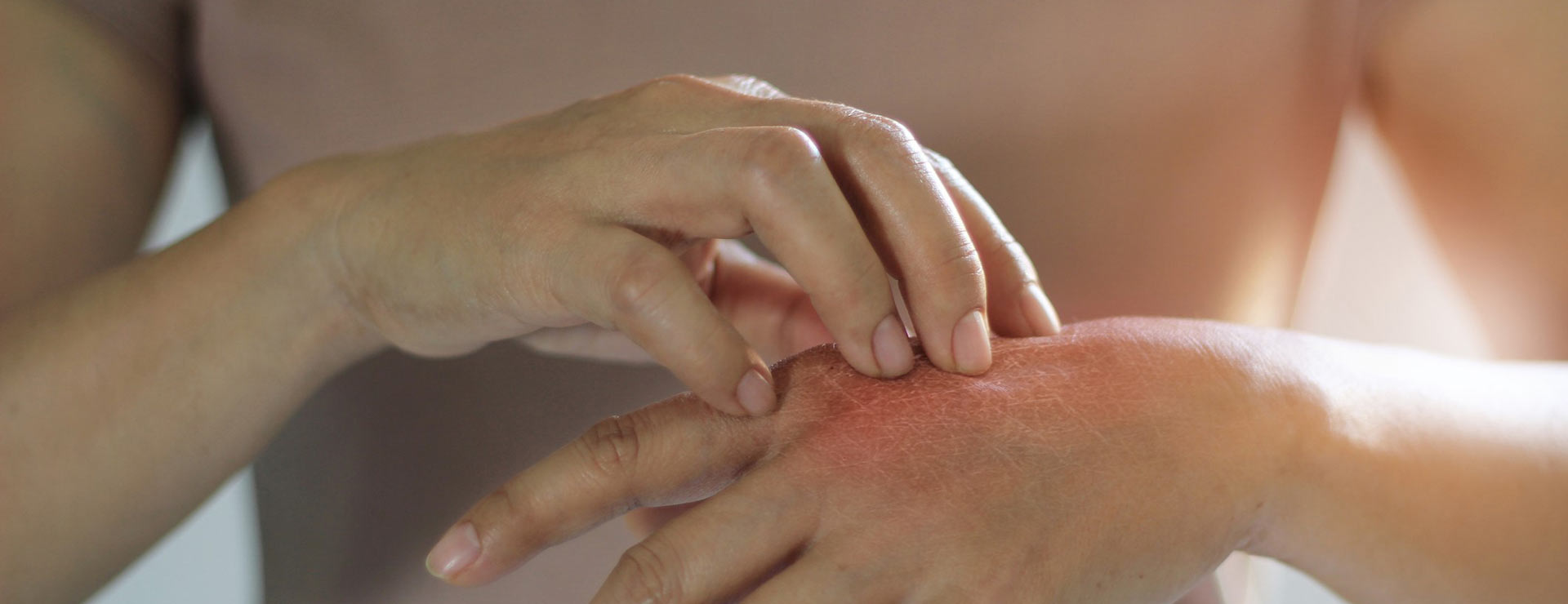 Woman scratching itchy, scaly skin on her hand