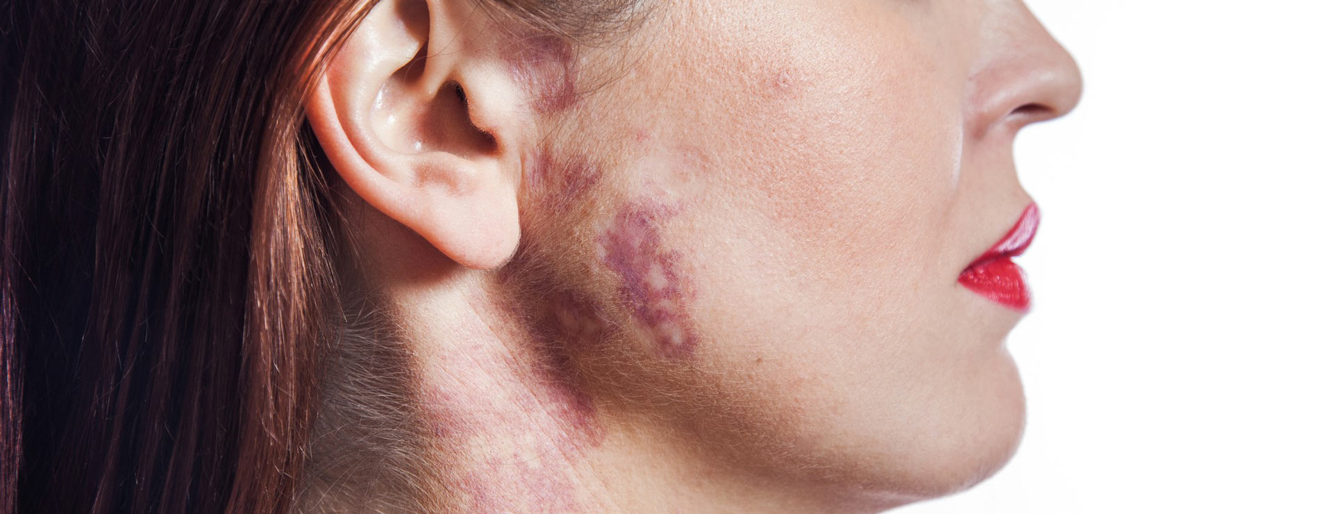 Woman with a port-wine stain birthmark on her cheek