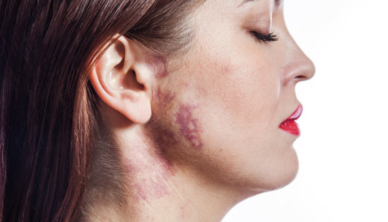 Woman with a port-wine stain birthmark on her cheek