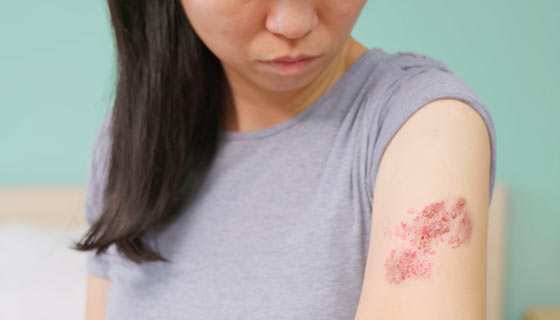 Rash Arm Rash Drug Rashes | Johns Hopkins Medicine