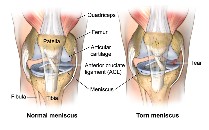 Anatomy of the knee showing a healthy meniscus and a torn meniscus.