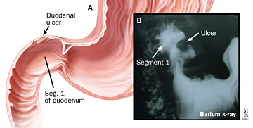 diagram of a duodenal ulcer