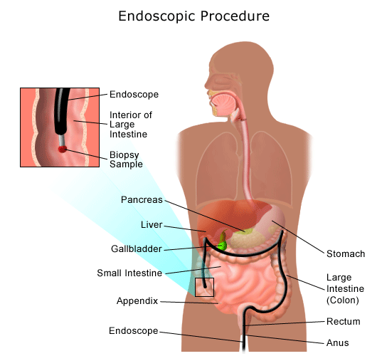 An illustration of an endoscopic procedure.
