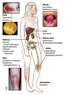https://www.hopkinsmedicine.org/-/media/images/health/1_-conditions/stomach-and-gut/extraintestinal-manifestations-of-crohns-disease.jpg?h=360&iar=0&mh=360&mw=520&w=246&hash=B331BCA03C70535D866A2EF9F5BCA1DB
