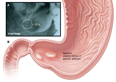 diagram of a gastric ulcer