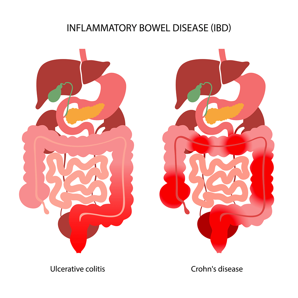 Graphic of inflammatory bowel disease in the stomach and gut.