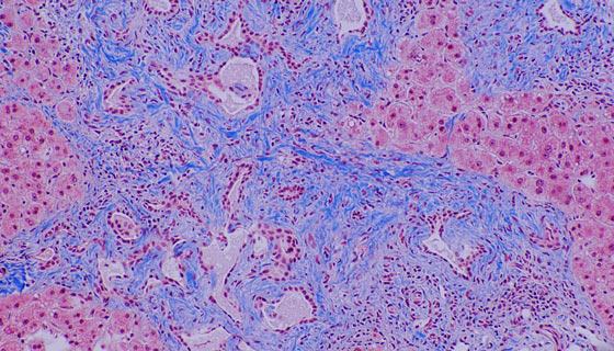 Liver tissue with bile duct hamartoma