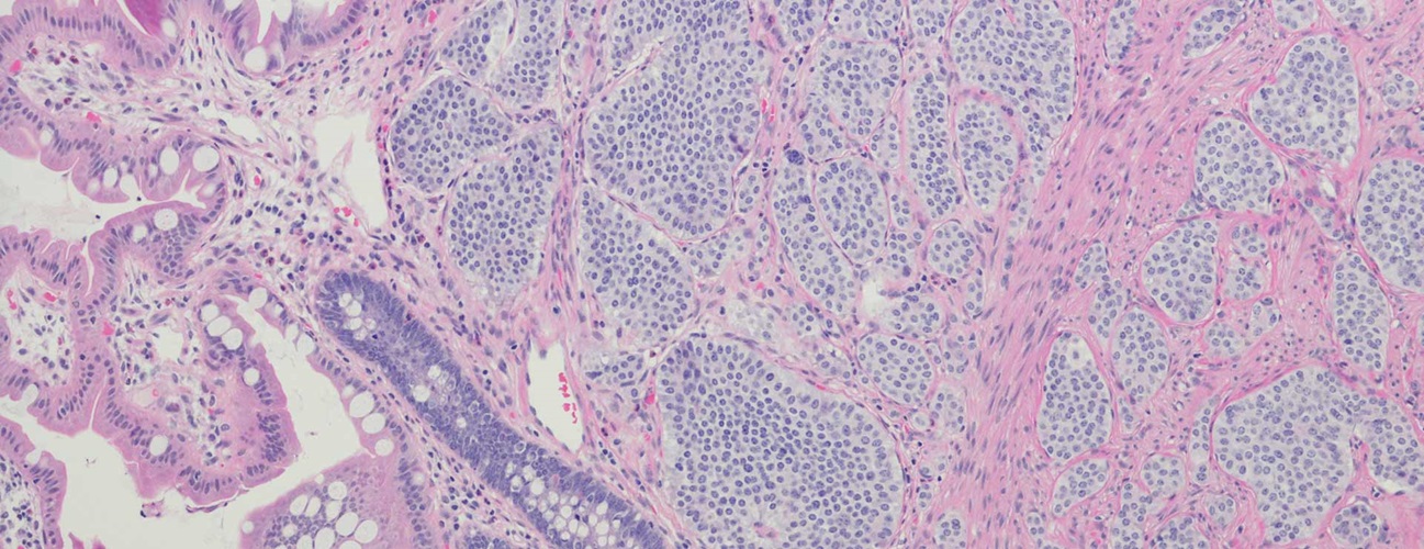 carcinoid tumor segment under the microscope
