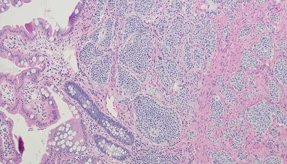 carcinoid tumor segment under the microscope