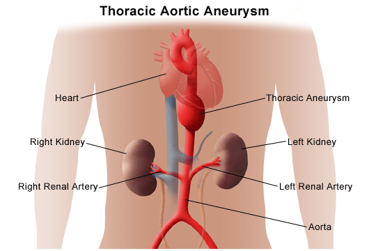 Thoracic Aortic Aneurysm Johns Hopkins Medicine