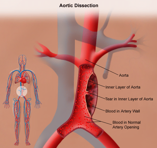 Thoracic Aortic Aneurysm Johns Hopkins Medicine