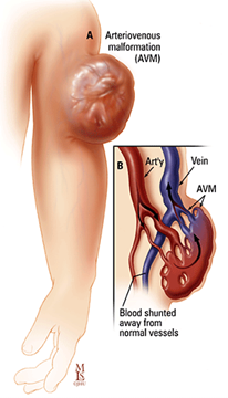 Illustration showing an Arteriovenous Malformation in the arm, with a zoom-in showing the veins and arteries tangled and blood shunted away from normal vessels.