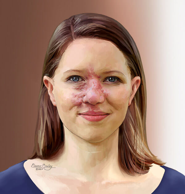 Illustration of a woman with an arteriovenous malformation.