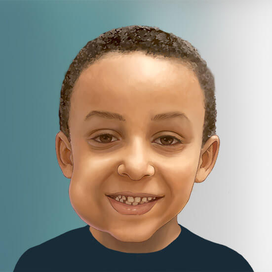 Illustration of a child with a lymphatic malformation on his face.