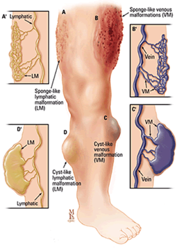 Illustration showing multiple types of vascular malformations in a leg, including lymphatic and venous malformations.