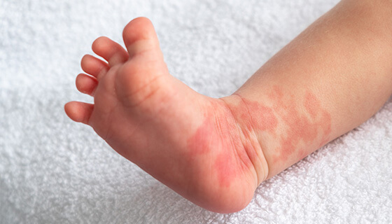 Red birthmark on the leg of newborn baby.