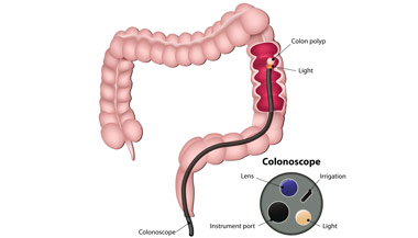 Colonoscopy illustration