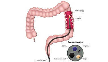 Colon Study Colon Cancer Diagnosis | Johns Hopkins Medicine