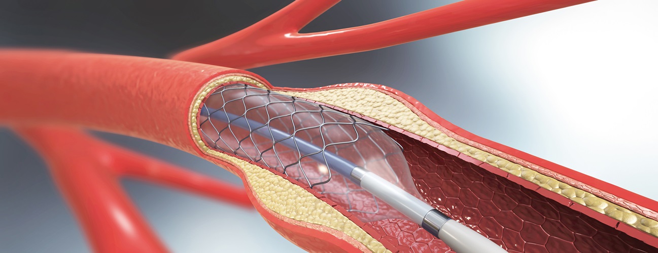 Angioplasty After a Heart Attack: Risks and Benefits
