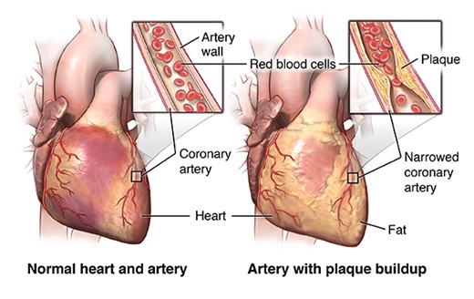 Clogged Artery Model, English-Spanish