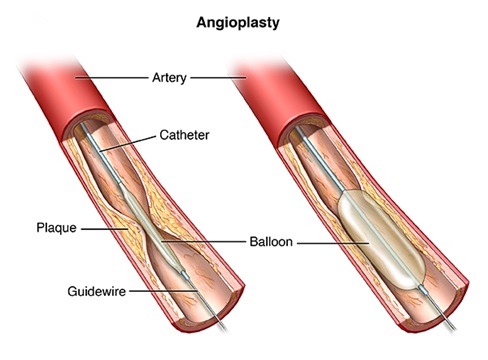 Coronary angioplasty and stents