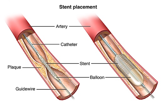 Spektakel Luxe Enten Angioplasty and Stent Placement for the Heart | Johns Hopkins Medicine
