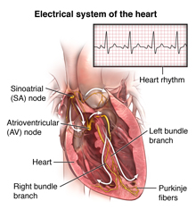 Can Your Heart Skip A Beat With A Pacemaker Pacemaker Insertion Johns Hopkins Medicine