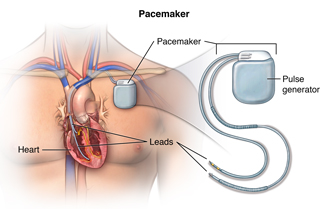 A pacemaker and it's position in the chest