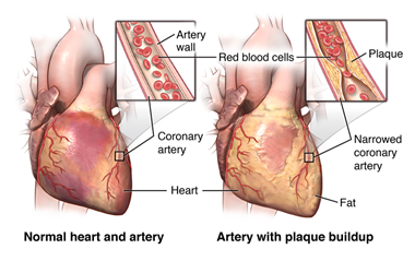 The heart and arteries, showing plaque build-up in arterial wall