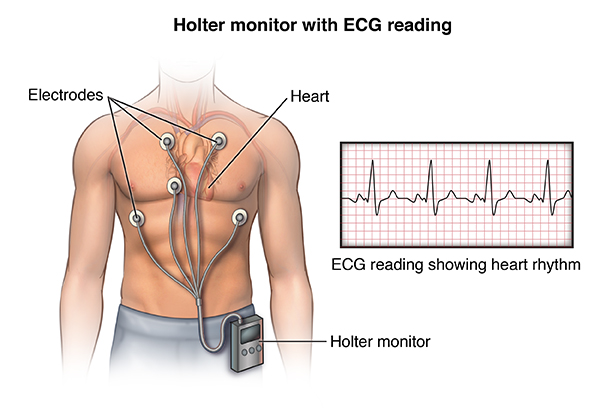 An illustration of the holter monitor device on a human body
