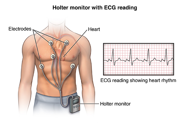 Holter monitor - Mayo Clinic