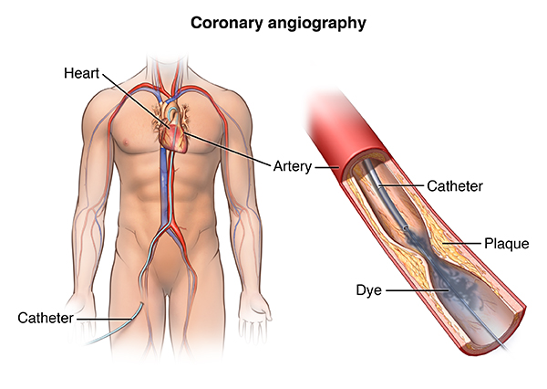 assignment on cardiac catheterization