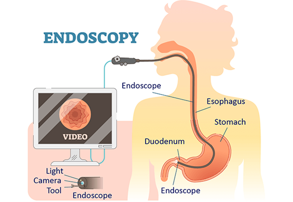 Illustration showing an endoscopic procedure.
