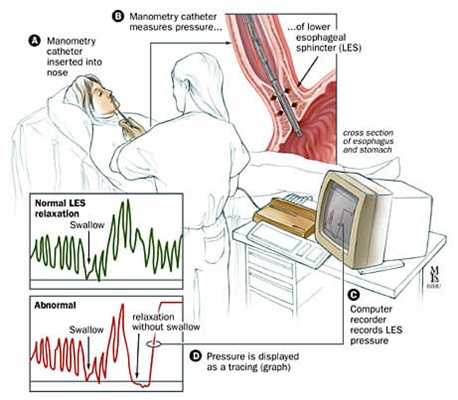 Illustration showing the components of an esophageal manometry procedure
