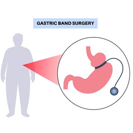 illustration depicting gastric band surgery