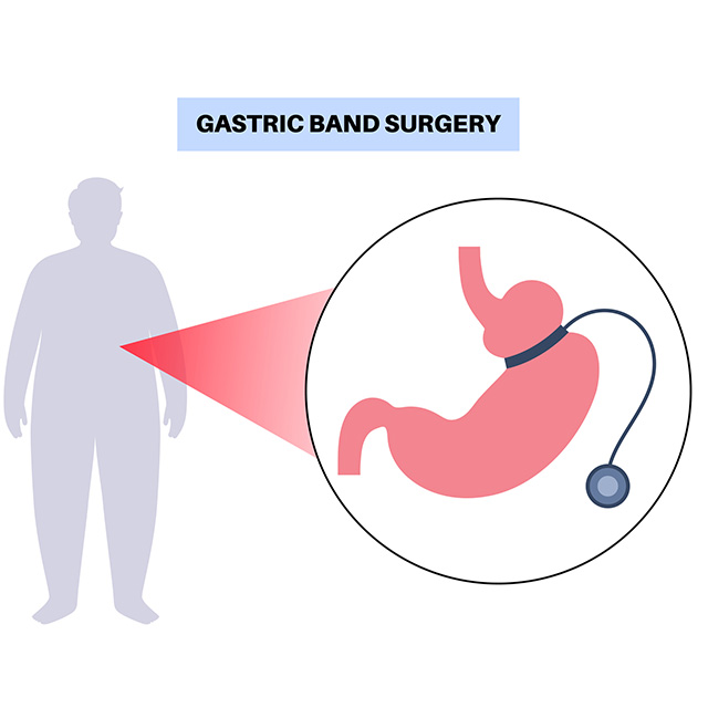 illustration depicting gastric band surgery