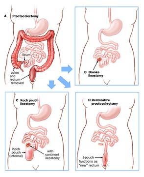 Diagram of four different surgeries to address ulcerative colitis