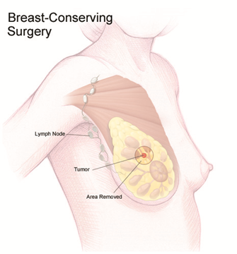 Illustration that explains breast-conserving surgery