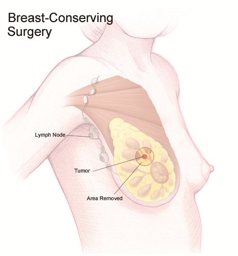 Breast-Conserving Surgery (Lumpectomy)