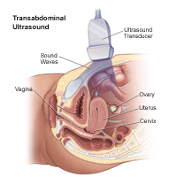 Illustration of a transabdominal ultrasound procedure" height=