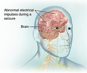 Electroencephalogram (EEG) | Johns Hopkins Medicine