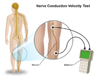 An illustration of a nerve conduction velocity test