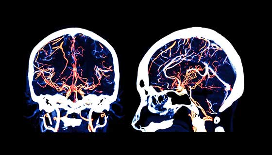 MRI scan of brain arteries