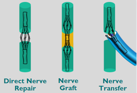 Diagram comparing three nerve repair procedures: direct nerve repair, nerve graft and nerve transfer