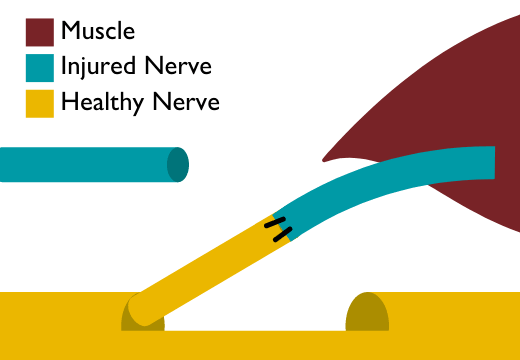 Illustration of a healthy nerve rerouted to a muscle connected to an injured nerve.