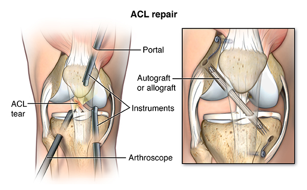 Illustration of ACL repair surgery